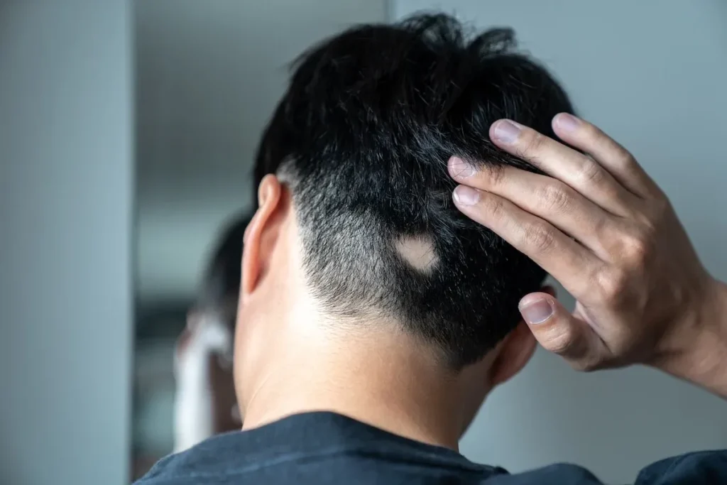 Genetic pathways that affect different types of alopecia
