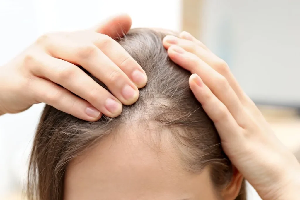 Professional assessment of frontal hair loss in women