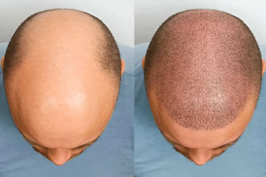 Understanding the 2000 Hair Graft Procedure