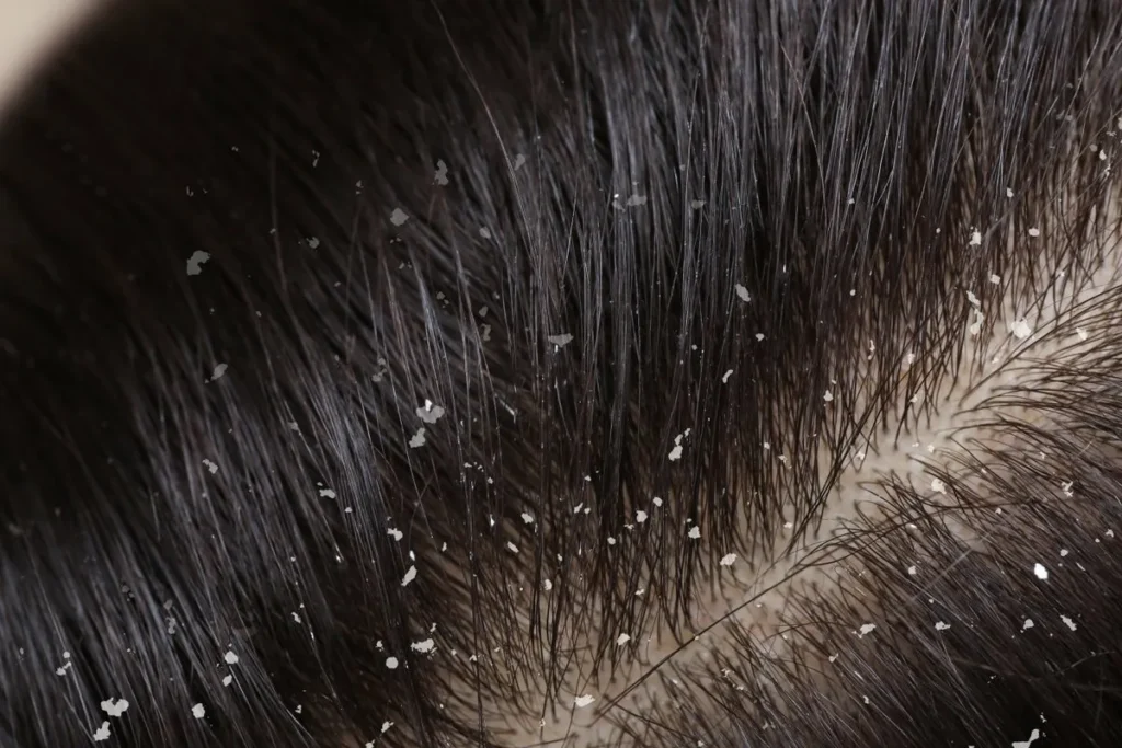 Understanding Dandruff and Why It Occurs