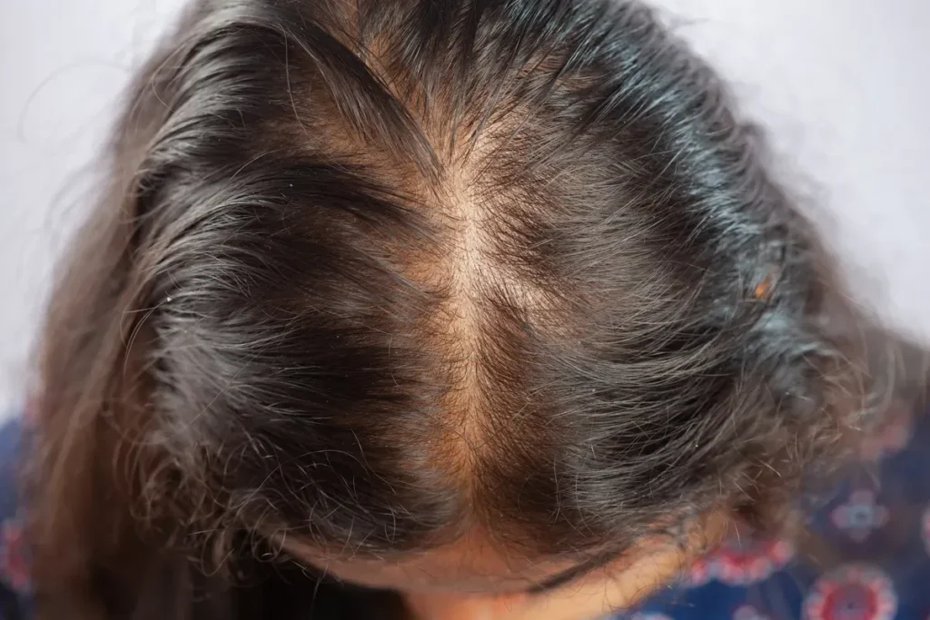 Fphl Hair Loss: 5 Shocking Signs Over 40