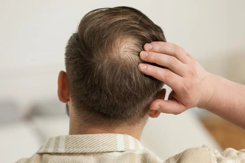 Early Stages Of Thinning Hair: 5 Easy Fixes