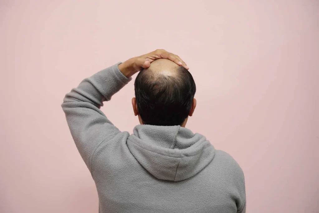 The Early Stages of Thinning Hair: Visual Indicators