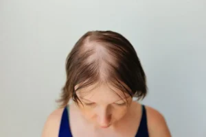 Common patterns of bald hair