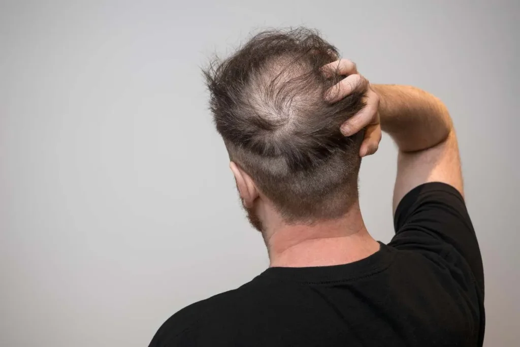 Erkek Tipi Kelliği Anlamak