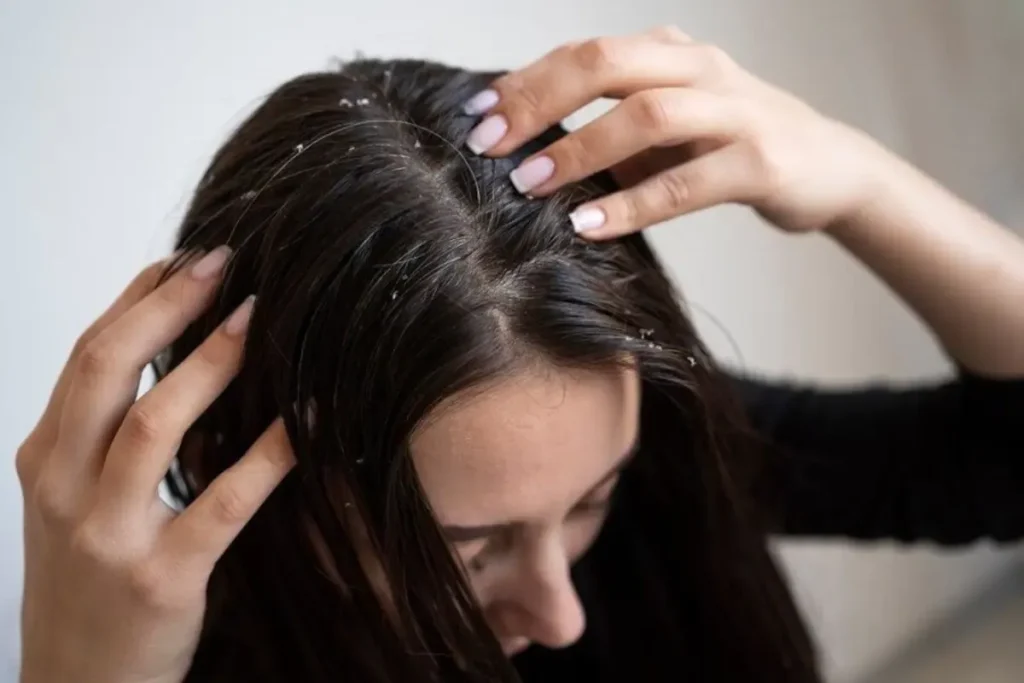 Understanding Selenium Sulfide as an Anti Dandruff Hair and Scalp Treatment