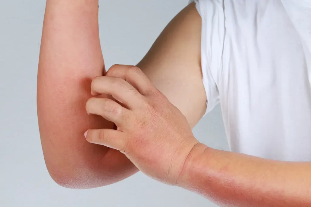 When Itchy Skin No Rash Could Signal Cancer