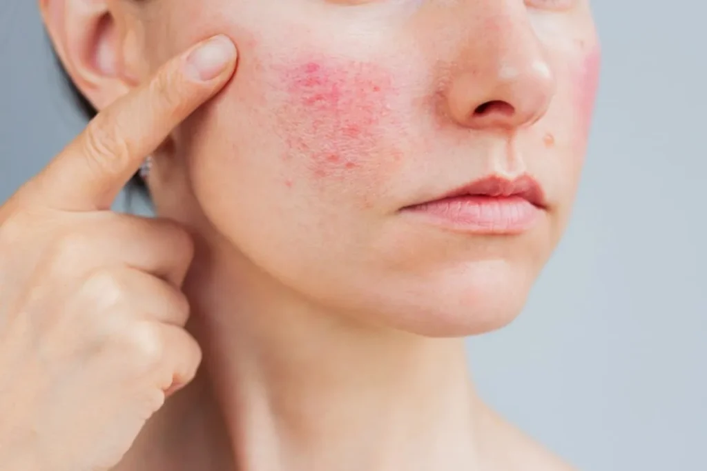 Understanding Facial Skin Irritation