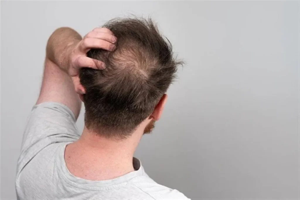 Understanding Early-Onset Male Pattern Baldness