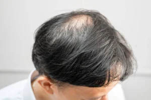 Common causes of hair loss explained