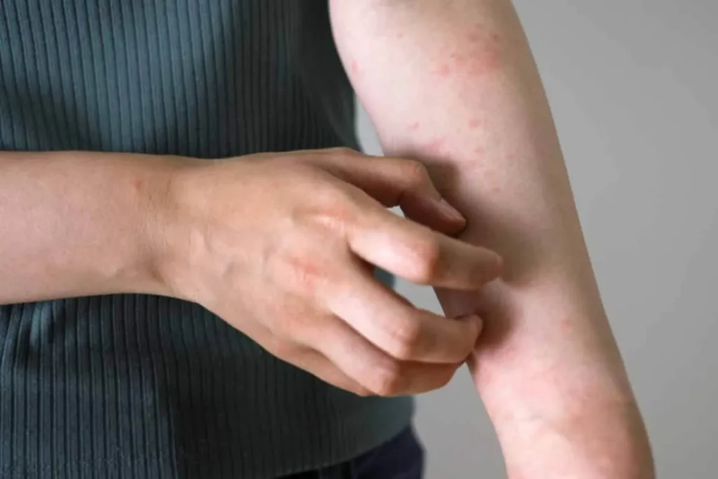 How to Treat Skin Rashes at Home Using Natural Remedies