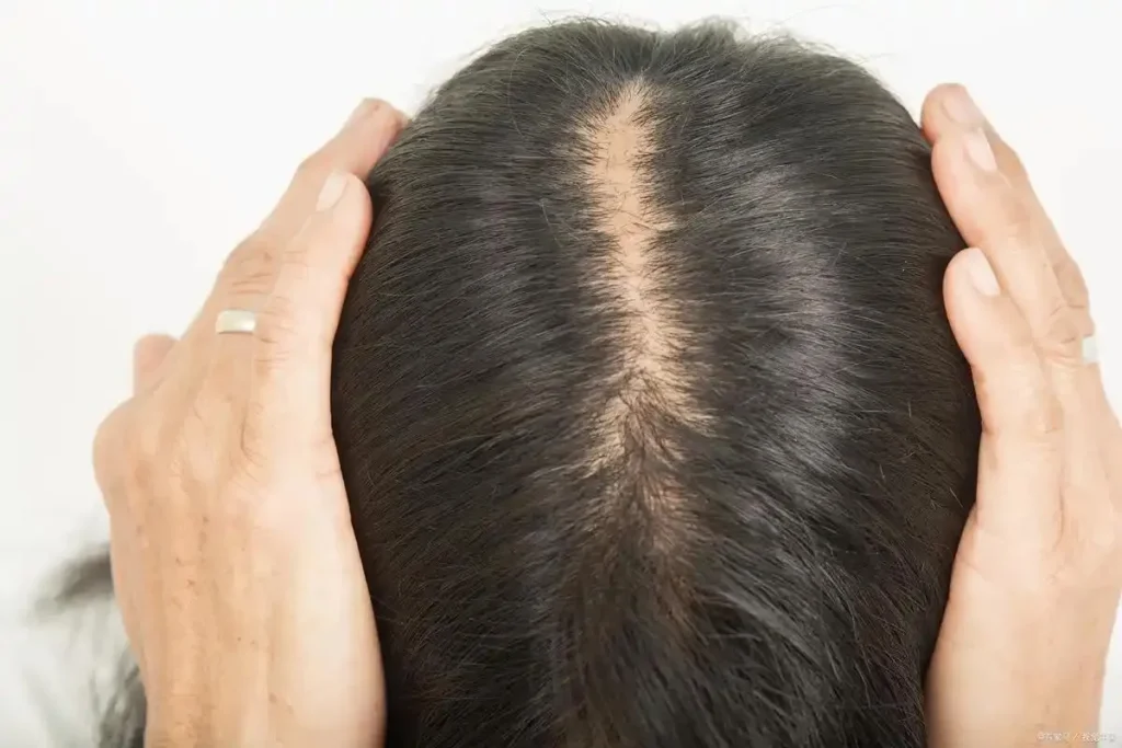 5 Best Postpartum Hair Loss Vitamins for Healthy Regrowth