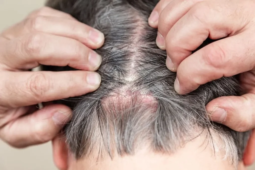 Boil On Head Under Hair: Quick Easy Cures