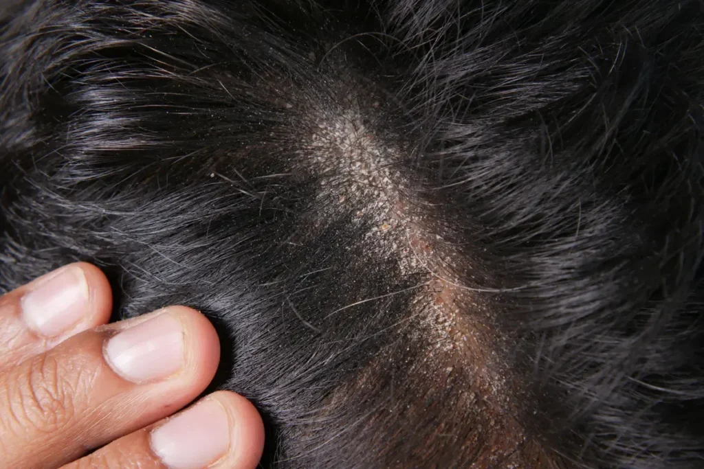 Bumps on Scalp Pictures: 7 Common Causes and Their Characteristics