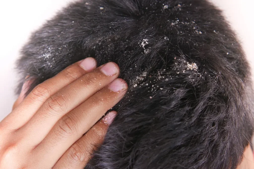 The Truth About Baldness and Dandruff