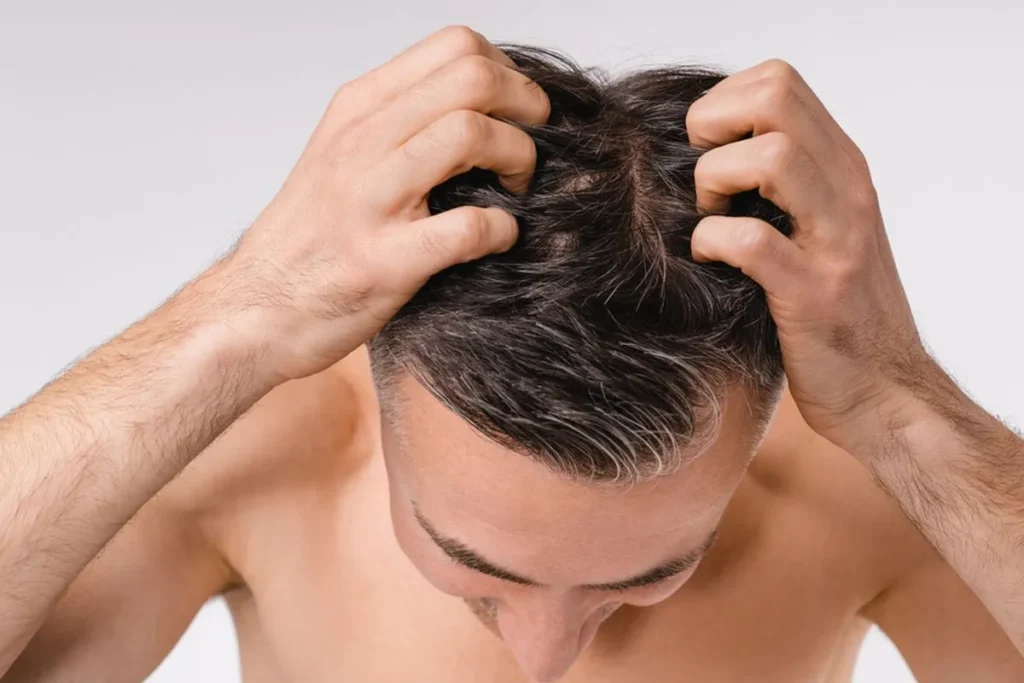 Why Bald People Can Stillexperience Dandruff