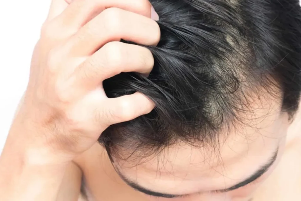 Bald Dry Scalp: Incredible Soothing Tips
