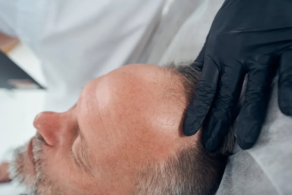 Understanding Bald Dry Scalp Conditions