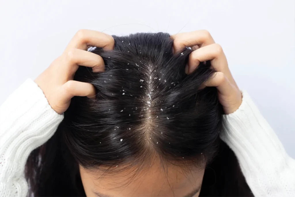 Understanding Dandruff: Causes and Symptoms