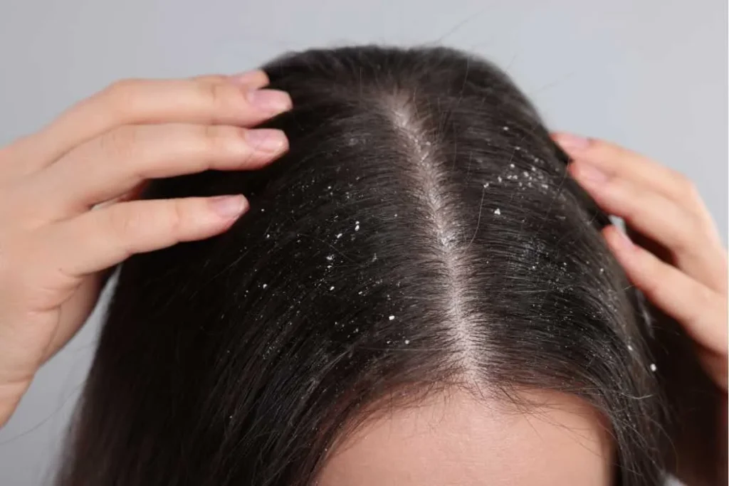 How Can I Get Rid of Dandruff Permanently with Natural Remedies