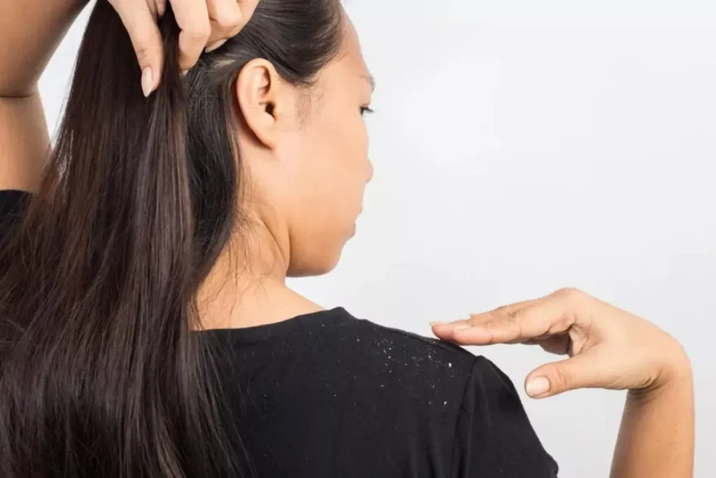 Understanding Dandruff in Curly Hair