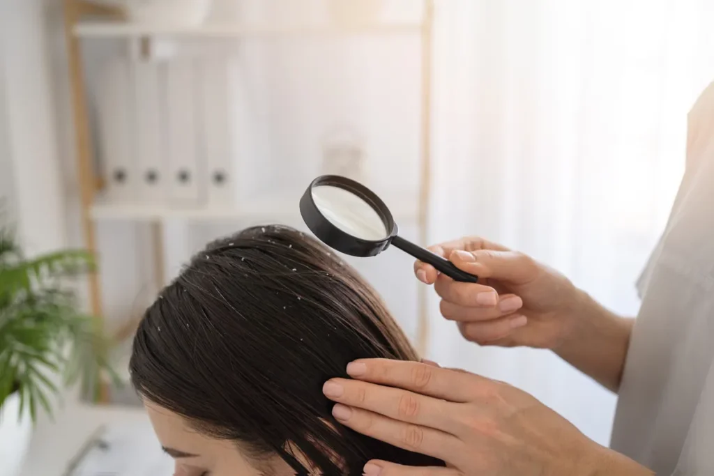 What Causes Dandruff? 5 Shocking Truths