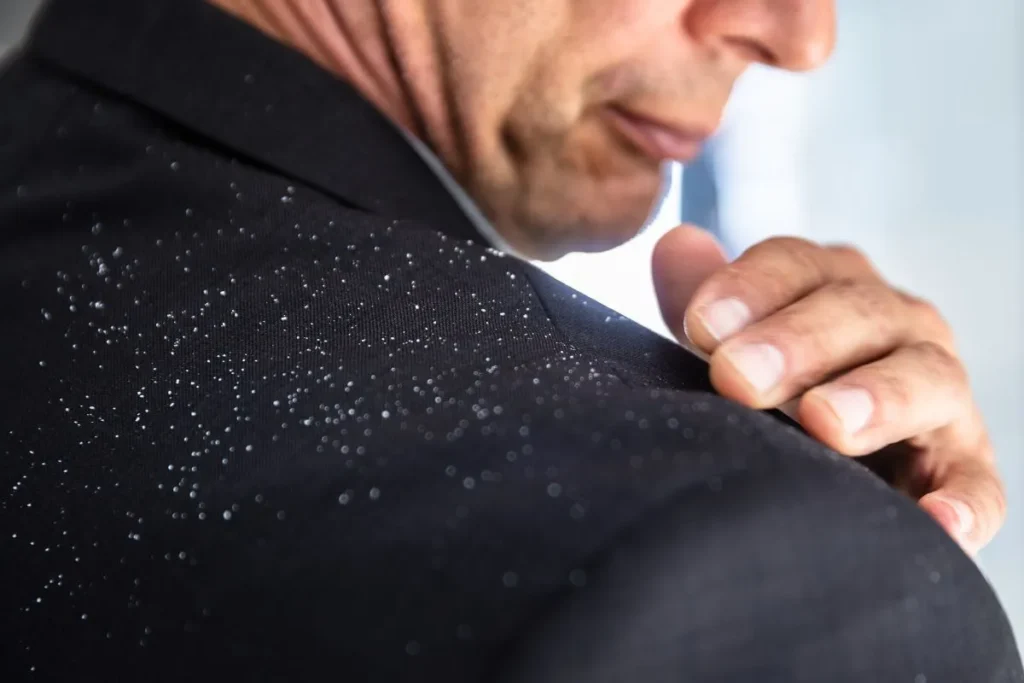 The Science Behind Dandruff: Causes and Contributing Factors