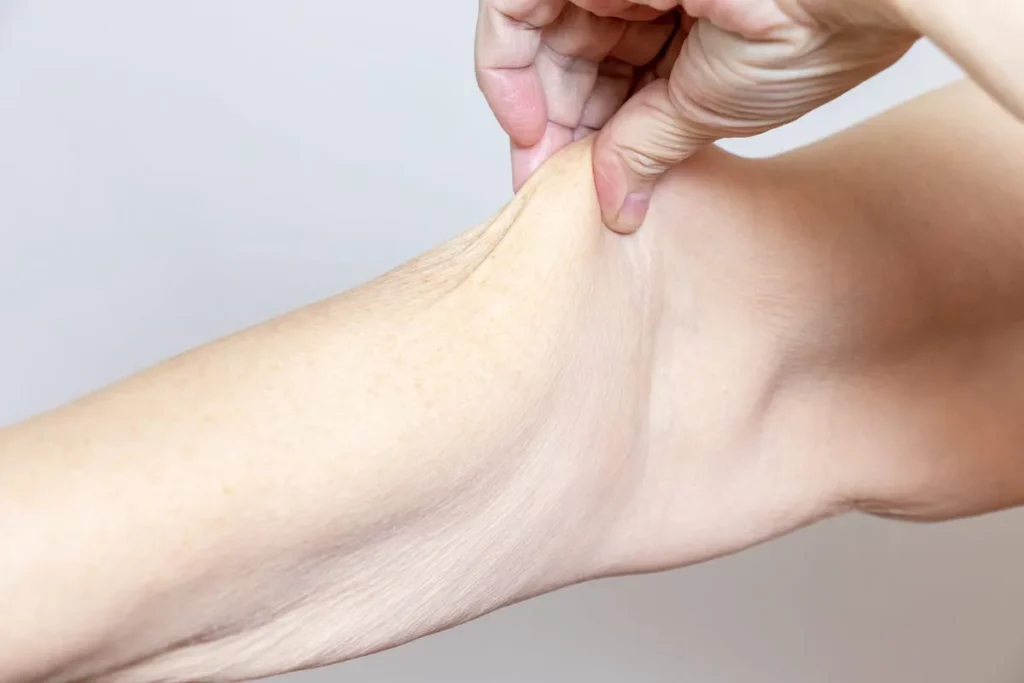 Understanding Skin Turgor and Dehydration