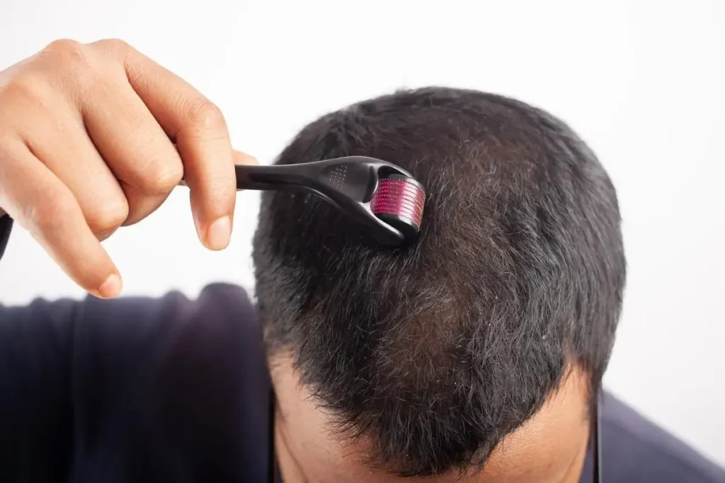 Derma Roller For Hair: Incredible Growth Wins