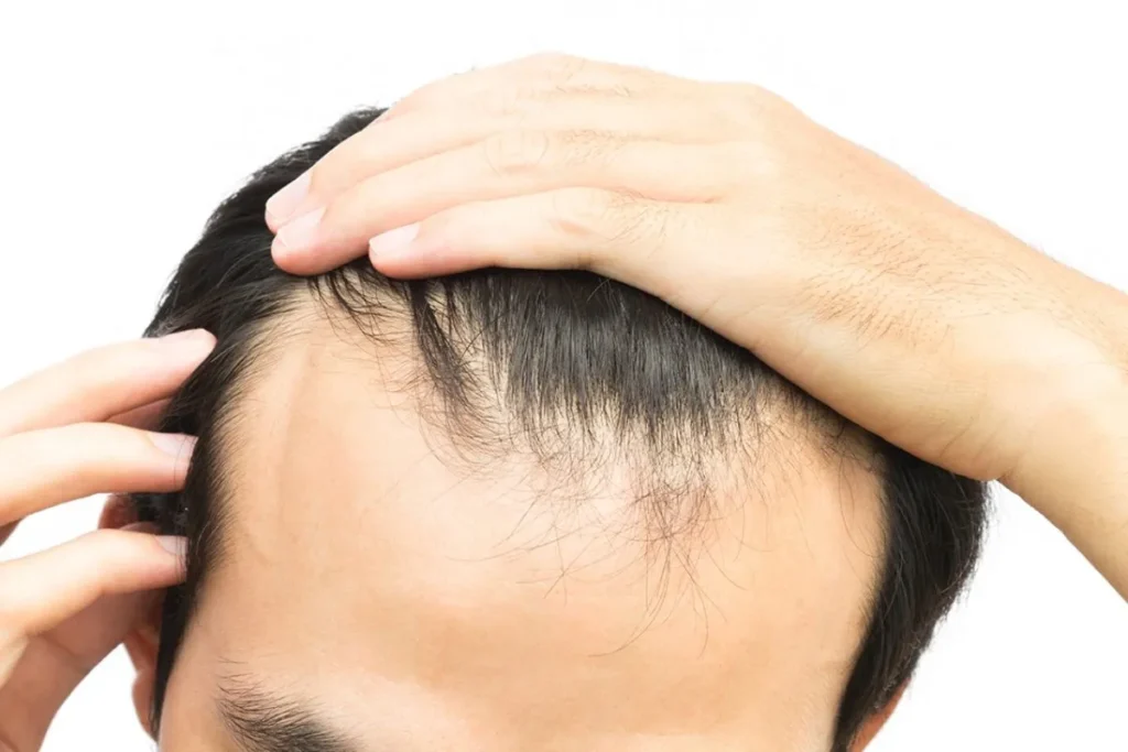 Does Radiation Cause Hair Loss? Mechanisms and Patterns