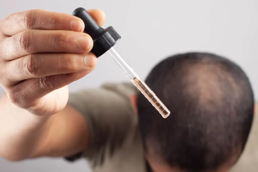 Dutasteride For Hair Loss: Incredible Results