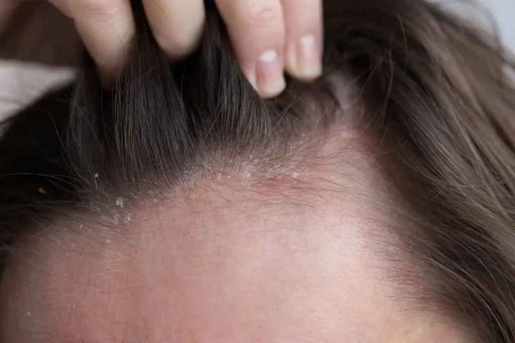 Identifying Pimple-Like Bumps on Scalp That Hurt