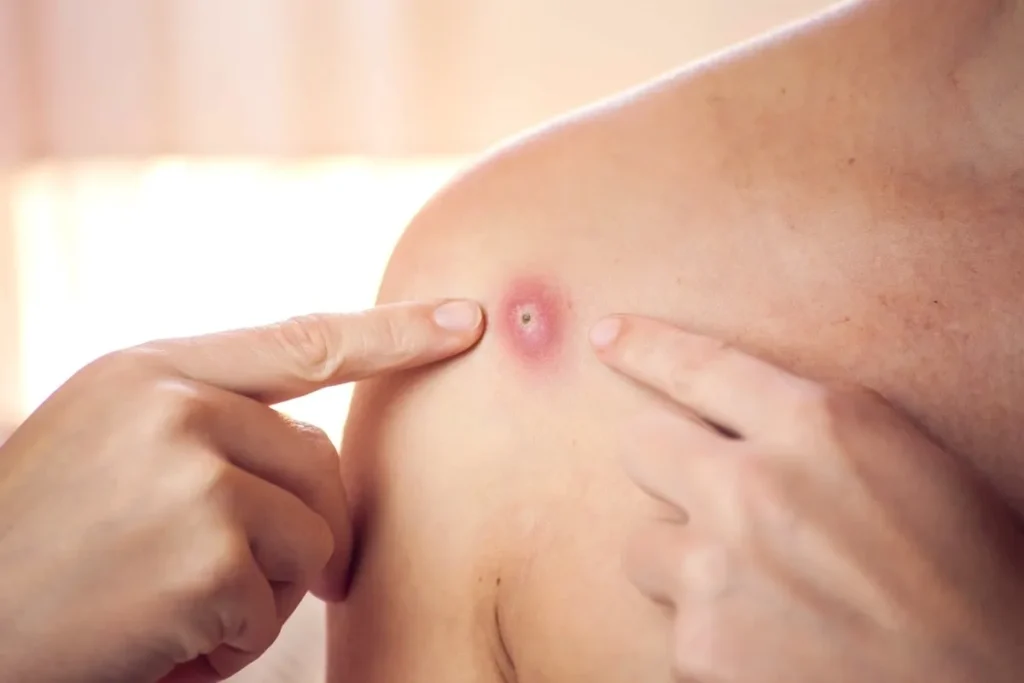 Understanding Folliculitis and Boils in the Groin Region