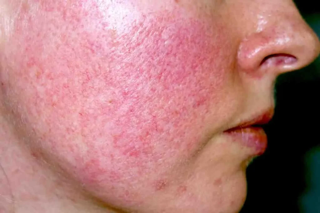 How to Get Rid of Folliculitis: Natural and OTC Treatments