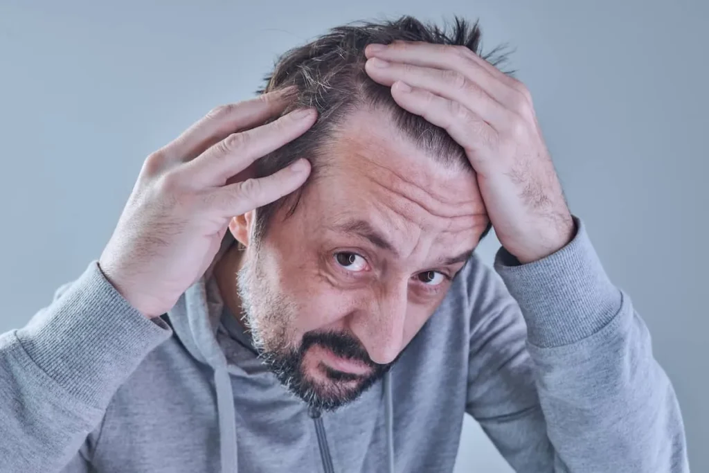 Frontal Fibrosing Alopecia: Crucial Facts