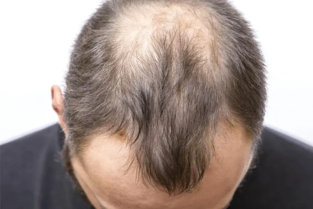 Understanding Frontal Fibrosing Alopecia