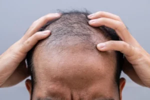 Can High Cortisol Cause Hair Loss? | Gold City Hair