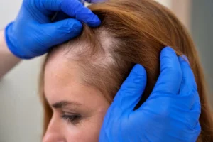 Is There a Cure for Alopecia? Exploring Treatment Options