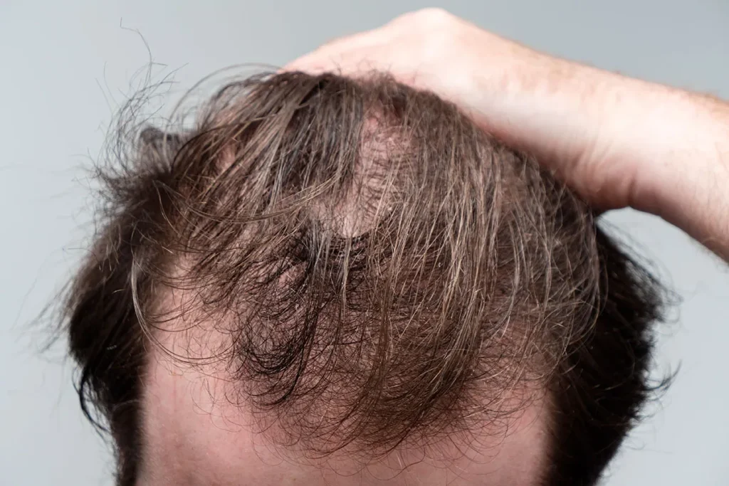 Hair Thinning On Side Of Head: Scary Truth