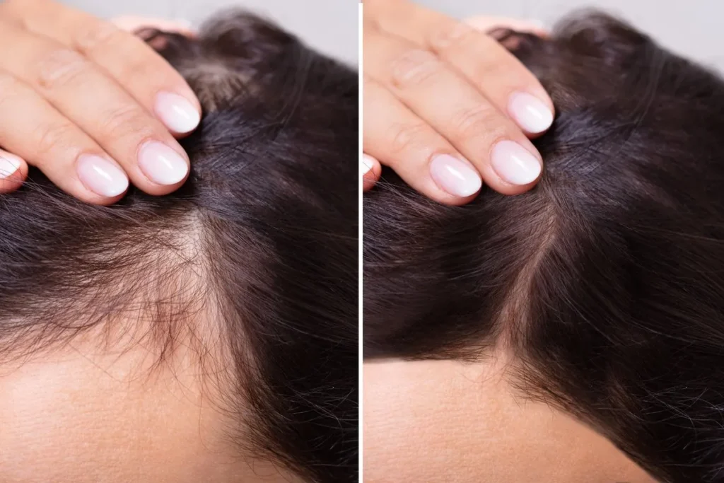 Hair Thinning On Sides: Amazing Powerful Fix