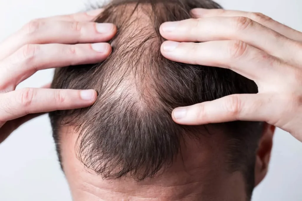 Signs Of Balding At 16: Scary Truth & Help
