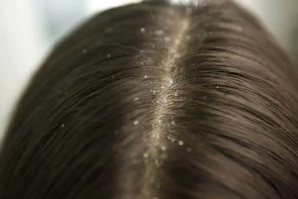 How To Heal Dry Scalp: Amazing Secrets