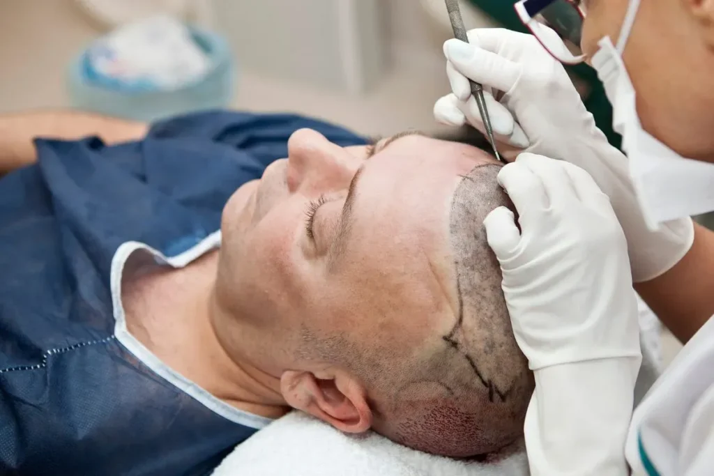 3 Months Post Hair Transplant: Big Growth