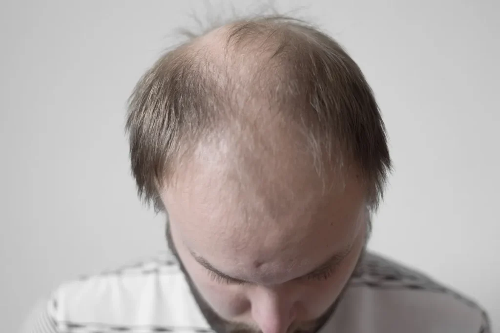 Chronic Telogen: Scary Truth & Recovery