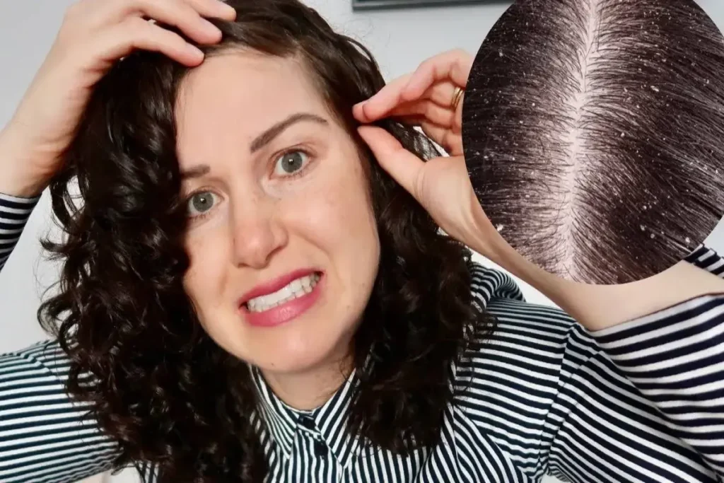 Scalp Buildup: Amazing Fast Incredible Fix