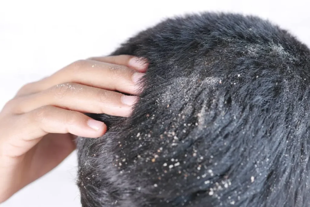 Psoriasis Dandruff: Scary Truth Revealed