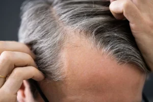 Illustration of one‑sided hairline thinning