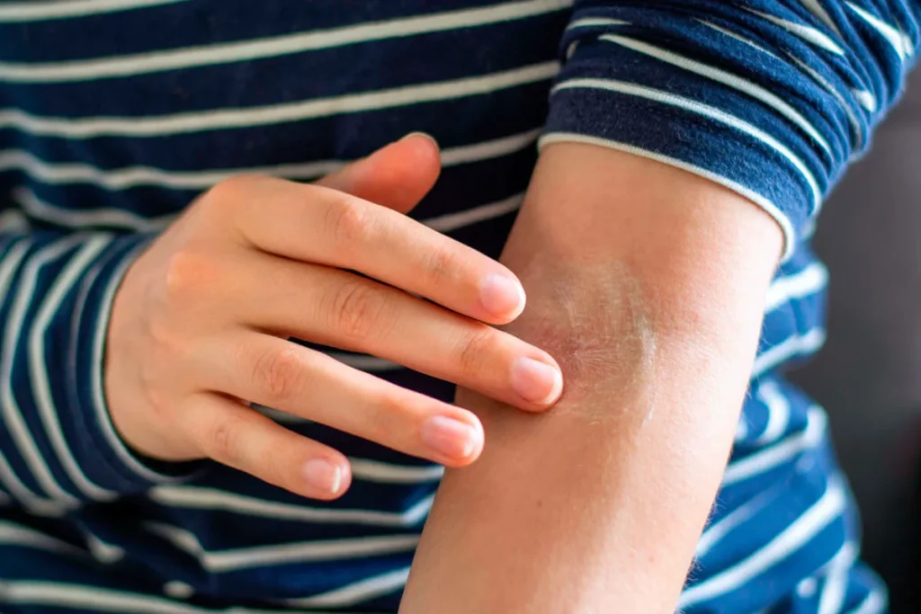 Scaly Patches On Skin: Incredible Cure