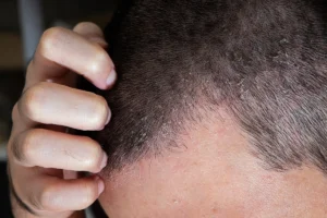Understanding Male Pattern Baldness and Its Triggers
