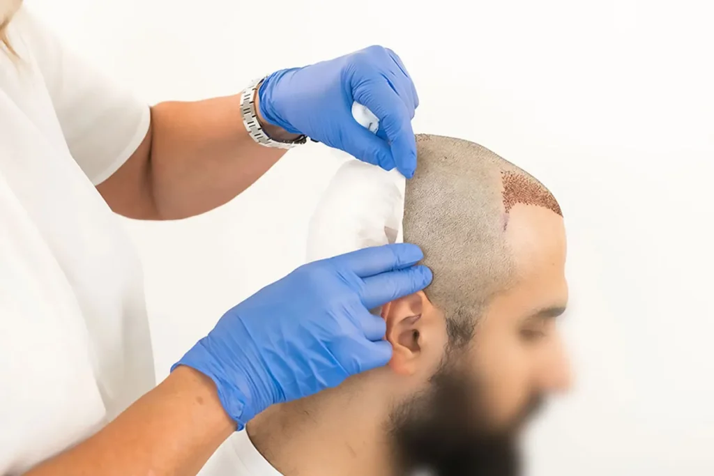Side Effects Hair Transplant Surgery: Truth